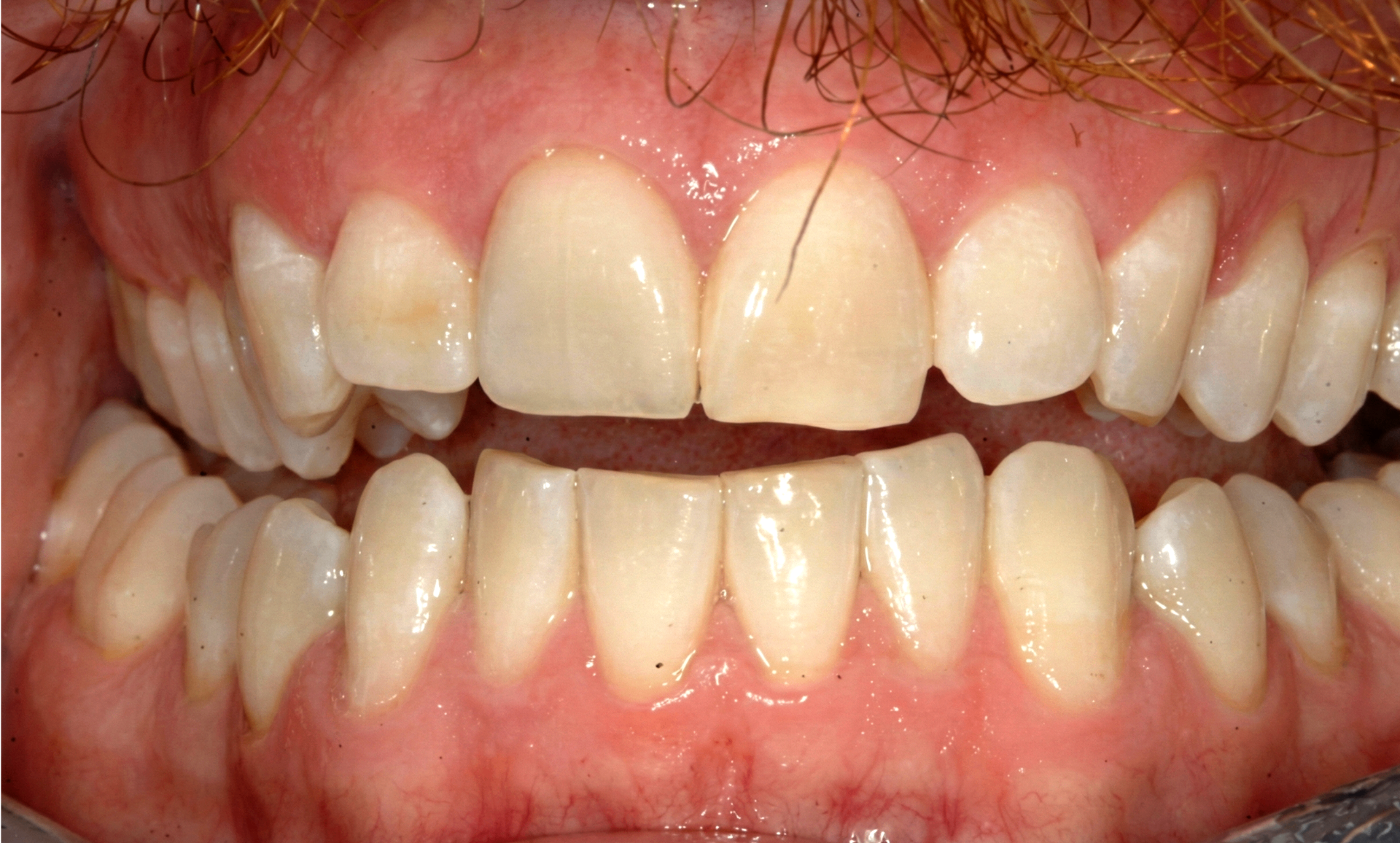 After treatment