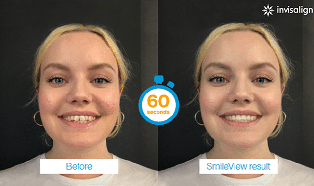 Invisalign Tumwater Olympia-SmileView smile simulation
