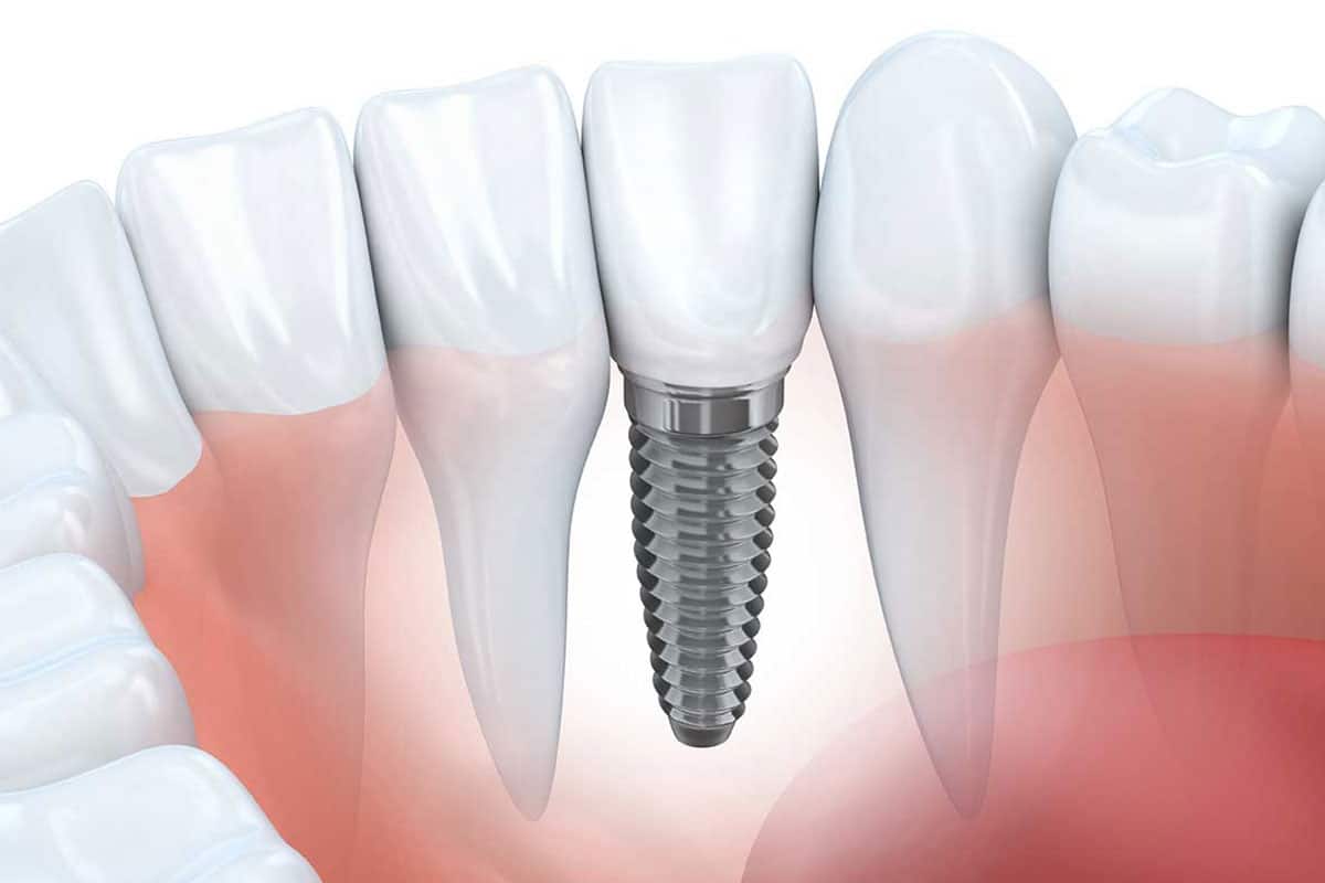 Dental Implants - Yamaguchi Family Dentistry - Tumwater Dentist